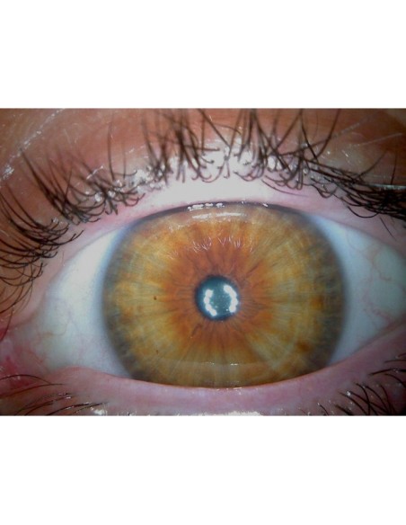 Video Iriscopio Irisoft